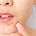 Metformin and Skin Health: How Insulin Resistance Affects Acne and Pigmentation