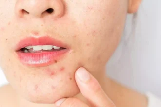 Metformin and Skin Health: How Insulin Resistance Affects Acne and Pigmentation