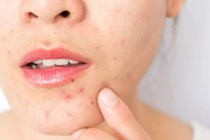 Metformin and Skin Health: How Insulin Resistance Affects Acne and Pigmentation
