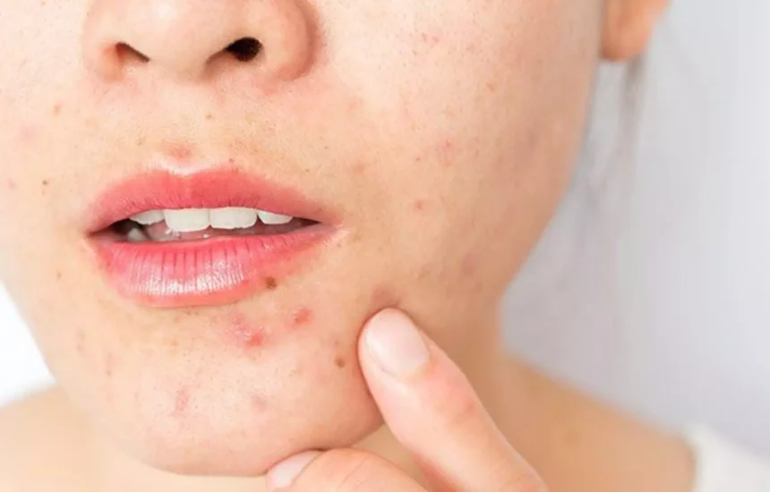 Metformin and Skin Health: How Insulin Resistance Affects Acne and Pigmentation
