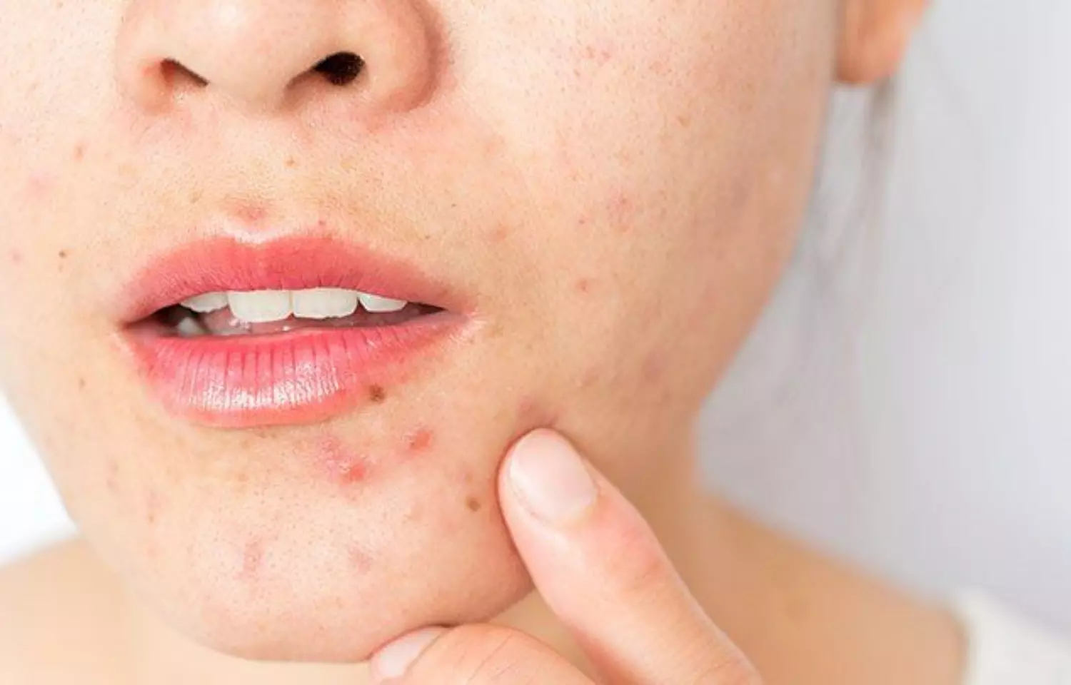 Metformin and Skin Health: How Insulin Resistance Affects Acne and Pigmentation